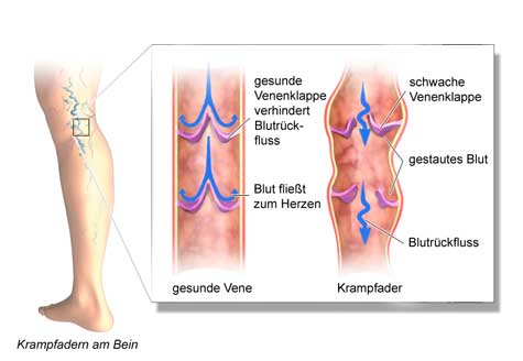 Schaubild zum Thema Krampfadern am Beim