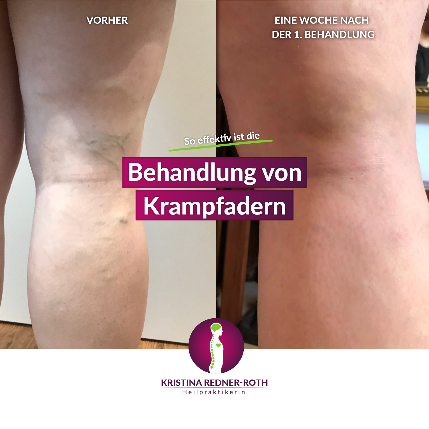 Bild eines Beins vor und nach der Krampfaderbehandlung. Vorher sind Krampfadern deutlich erkennbar, eine Woche nach der 1. Behandlung nicht mehr.