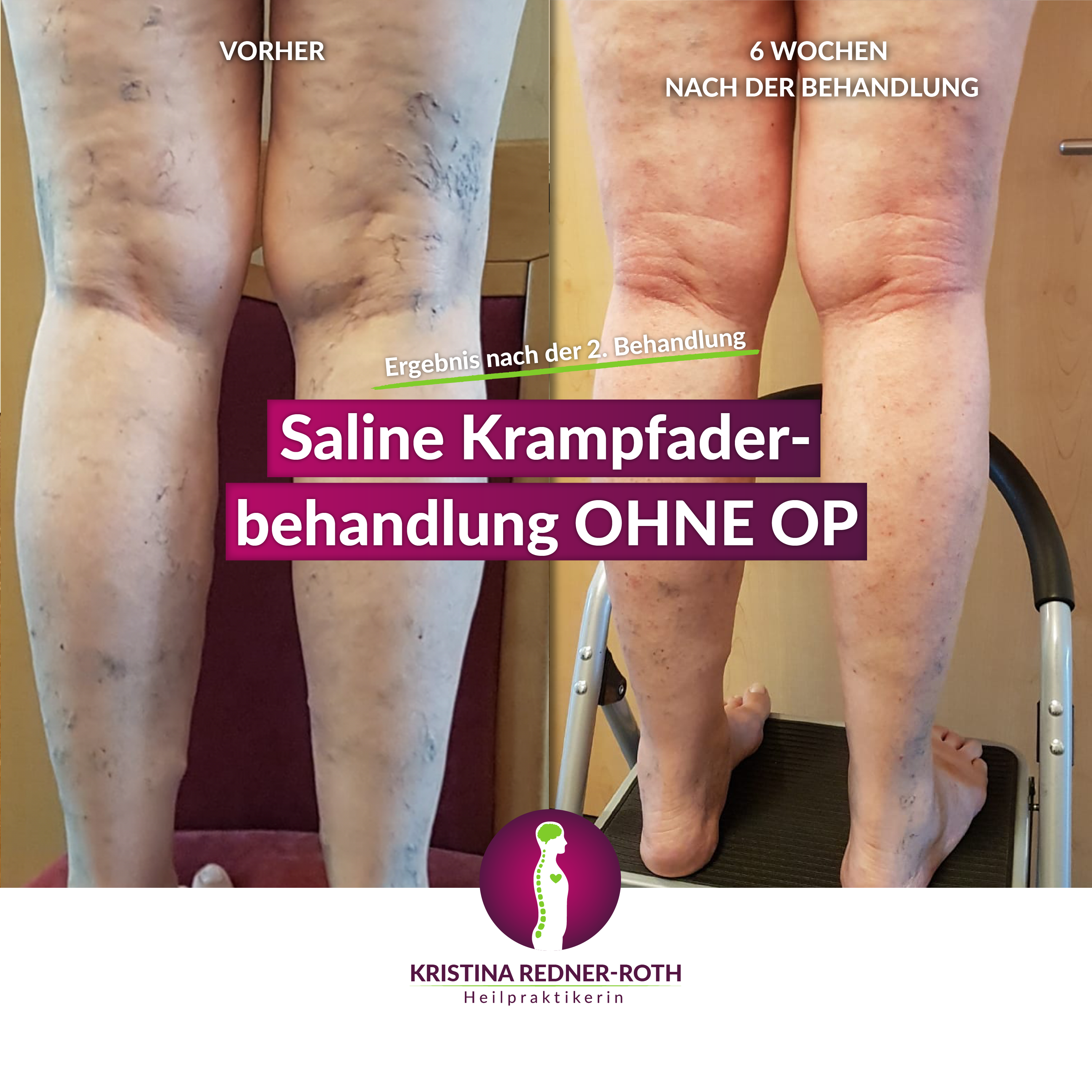 Bild eines Beins vor und nach der Krampfaderbehandlung. Vorher sind Krampfadern deutlich erkennbar, sechs Wochen nach der 2. Behandlung nicht mehr.