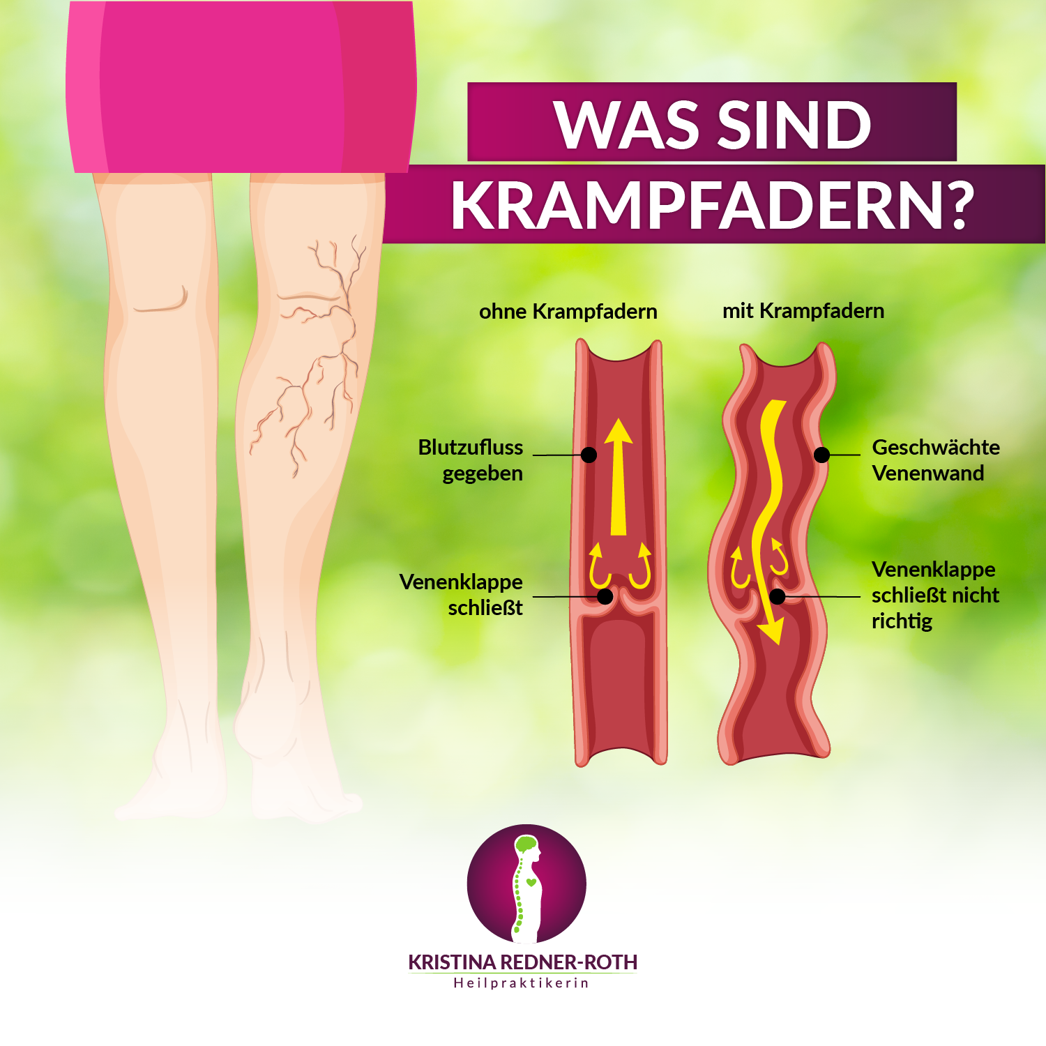 Schaubild, auf dem erklärt wird, was Krampfadern sind. Abgebildet sind zwei Venen, eine mit Krampfadern und eine ohne Krampfadern.